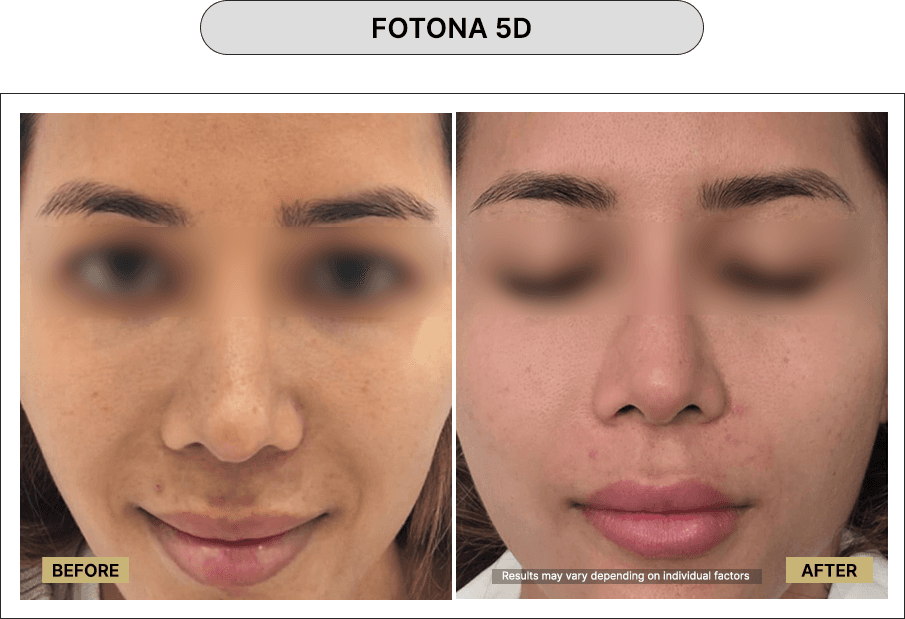 Fotona