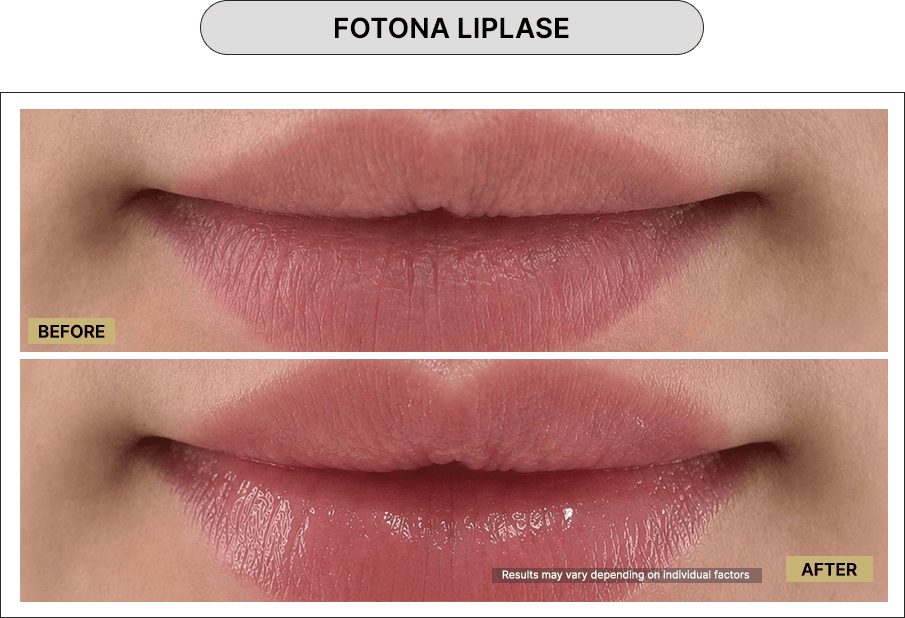 Fotona