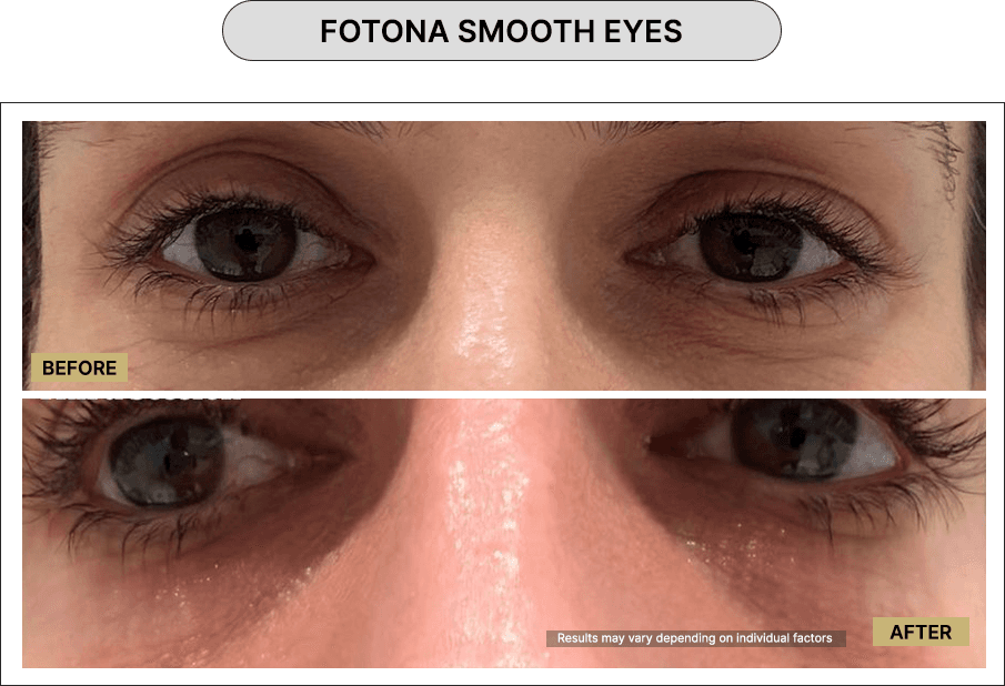 Fotona