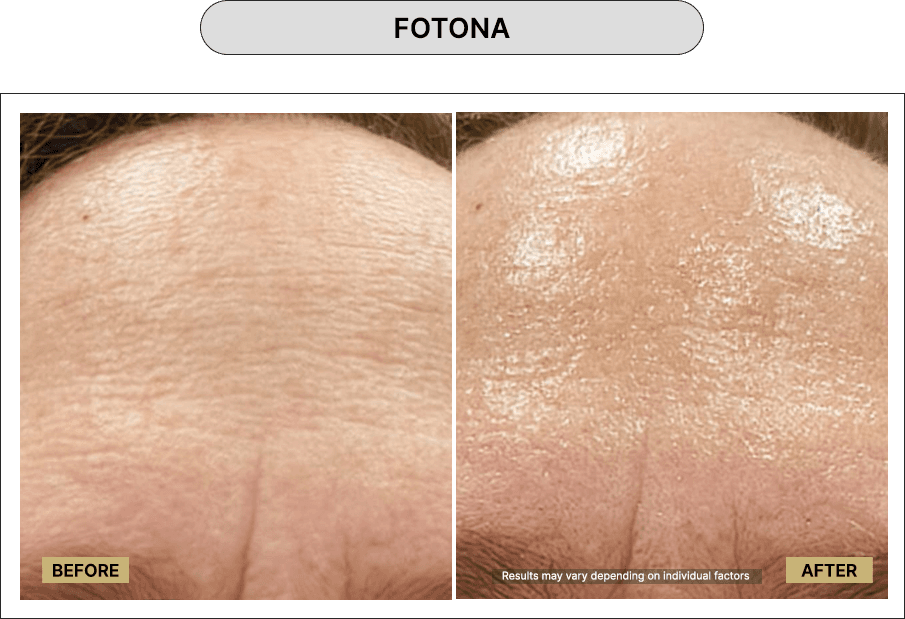 Fotona