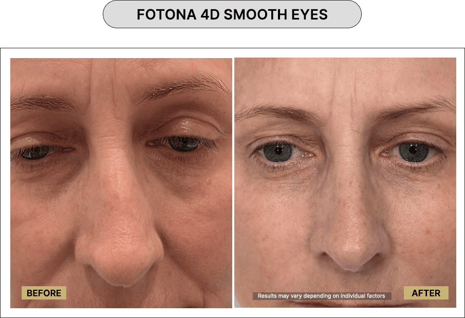 Fotona