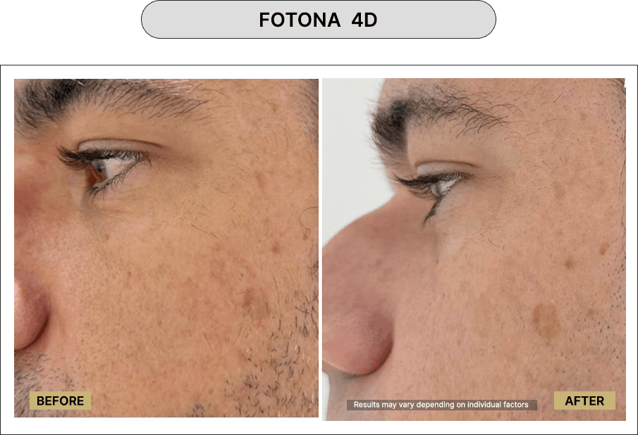 Fotona