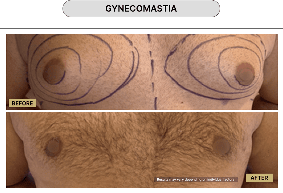 Gynecomastia