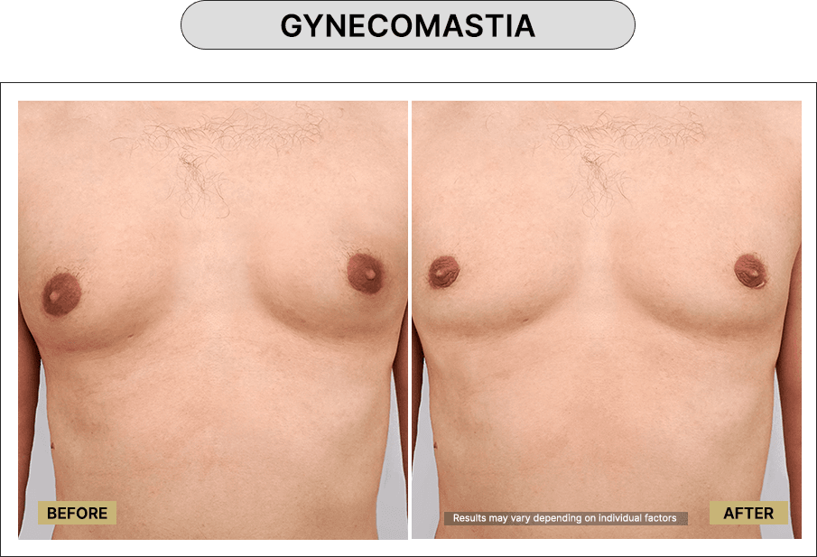 Gynecomastia