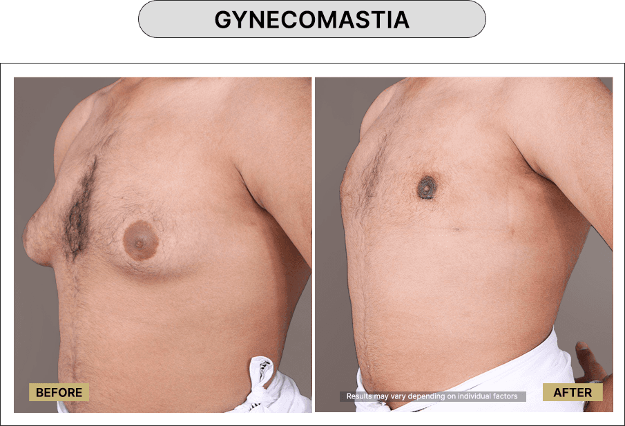 Gynecomastia