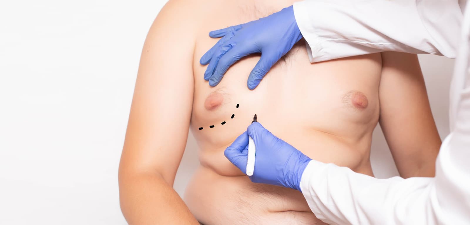 Gynecomastia in Dubai & Abu Dhabi