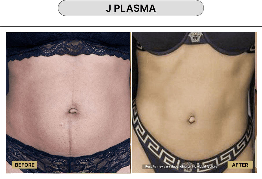 J Plasma