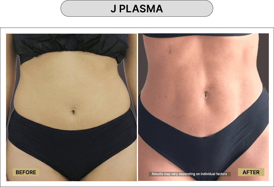 J Plasma