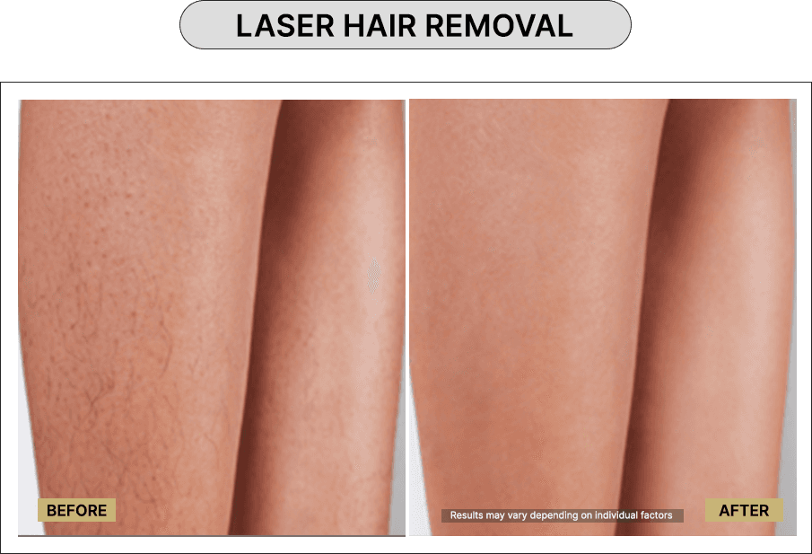 Laser hair removal