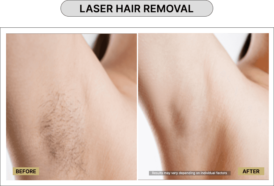 Laser hair removal