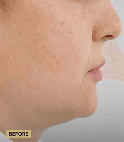 Lipolysis
