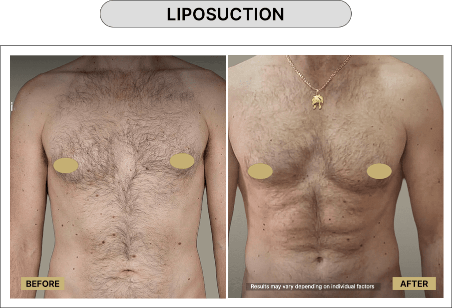 Liposuction