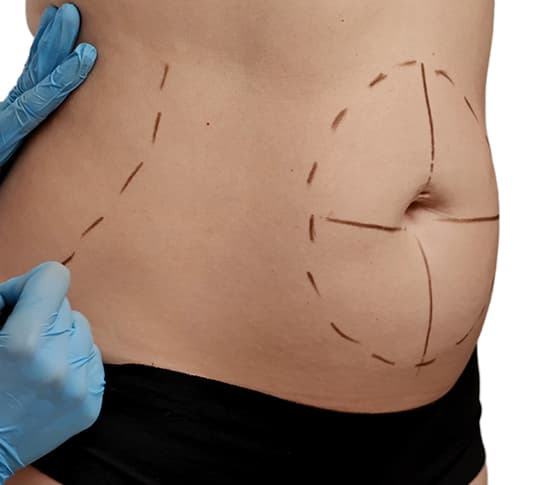 Liposuction