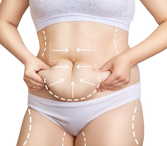 Liposuction