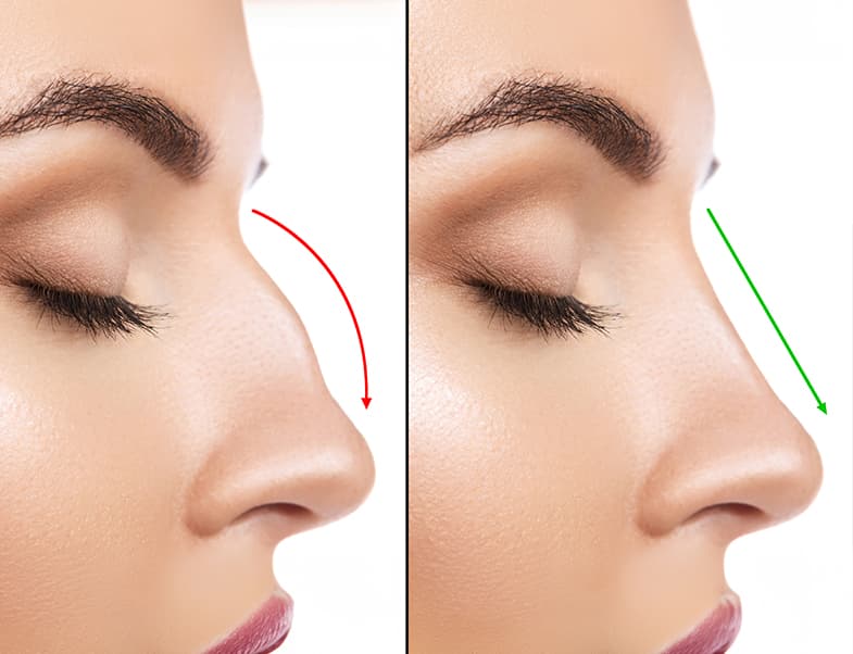 Nose reshaping surgery at SKIN111 Clinic Dubai for enhanced facial harmony
