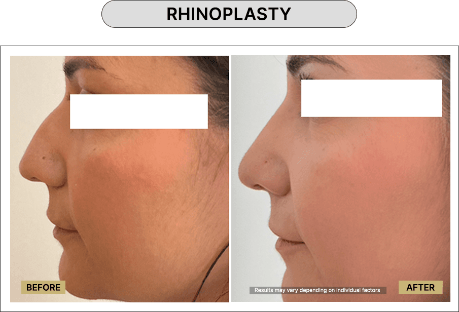 Rhinoplasty
