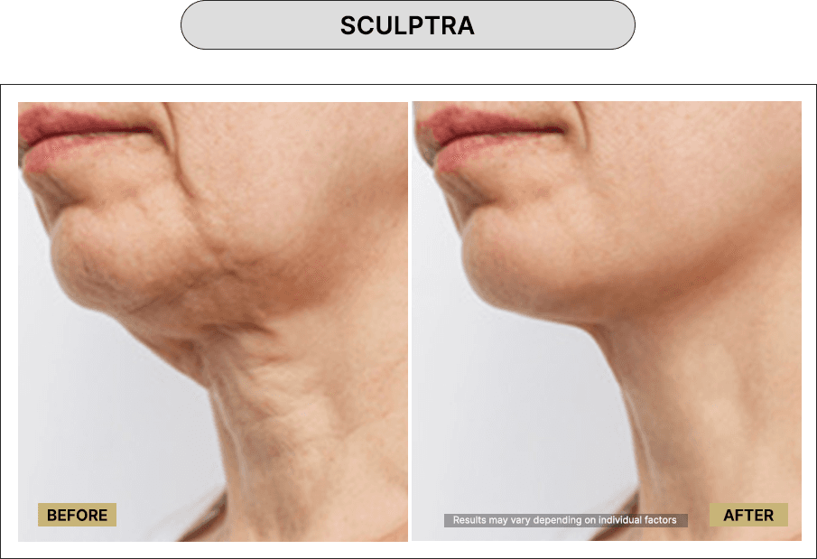 Sculptra