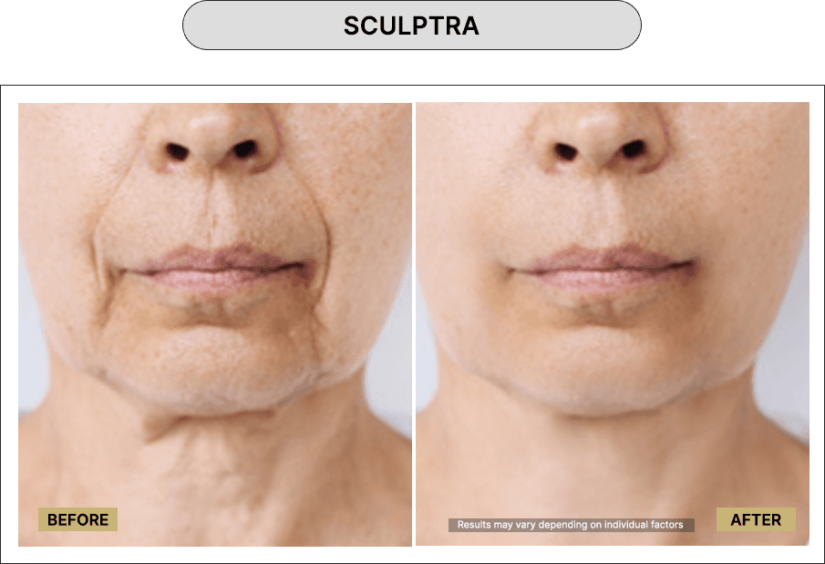 Sculptra