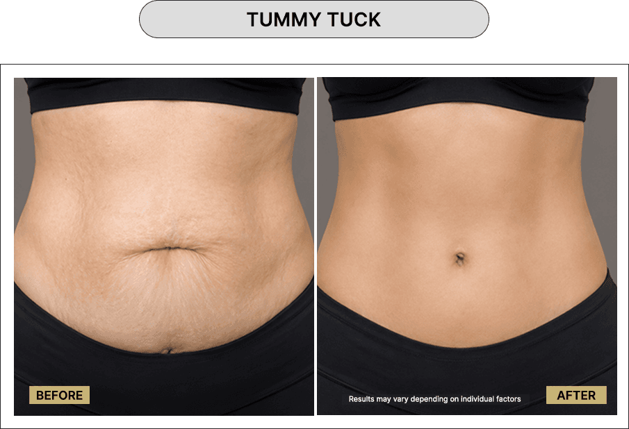 Tummy Tuck