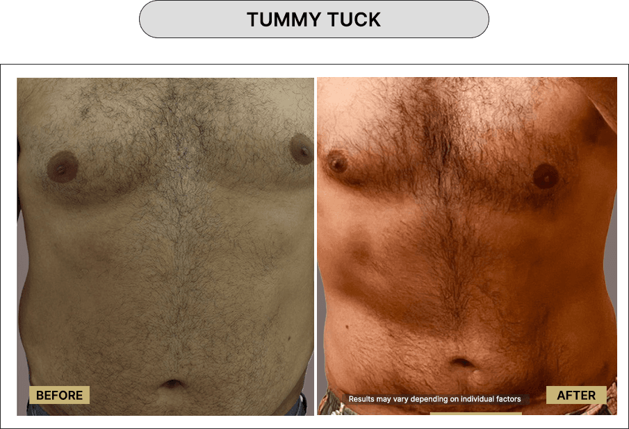Tummy Tuck