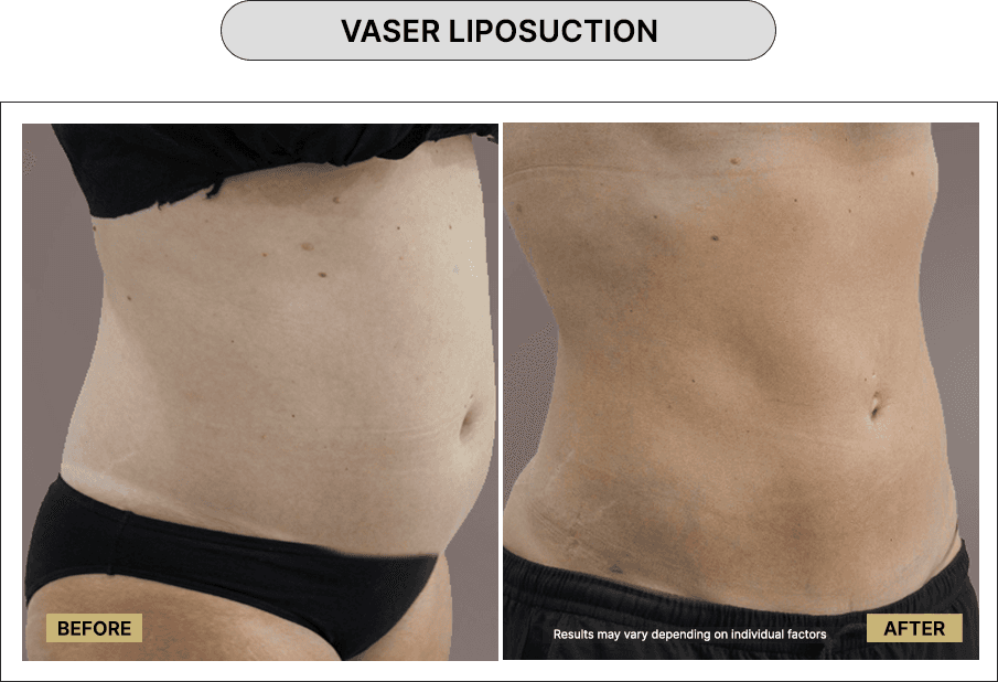 Vaser Liposuction