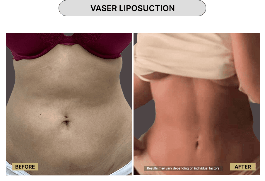 Vaser Liposuction
