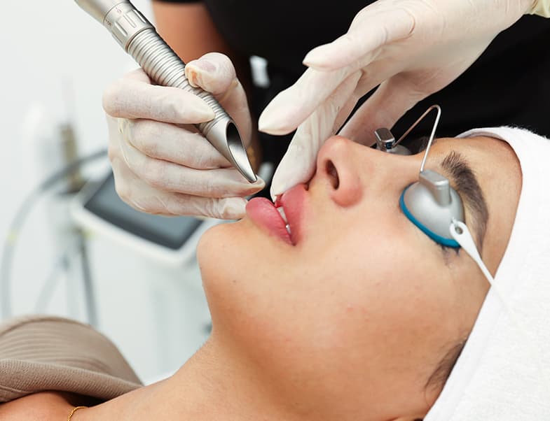 Laser hair removal