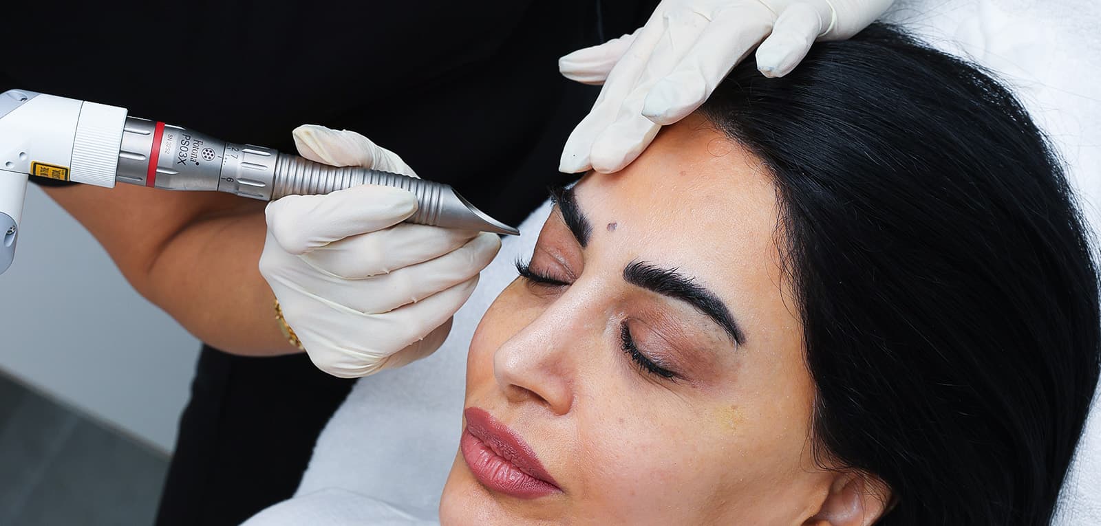 Fotona Laser Treatments in Dubai & Abu Dhabi