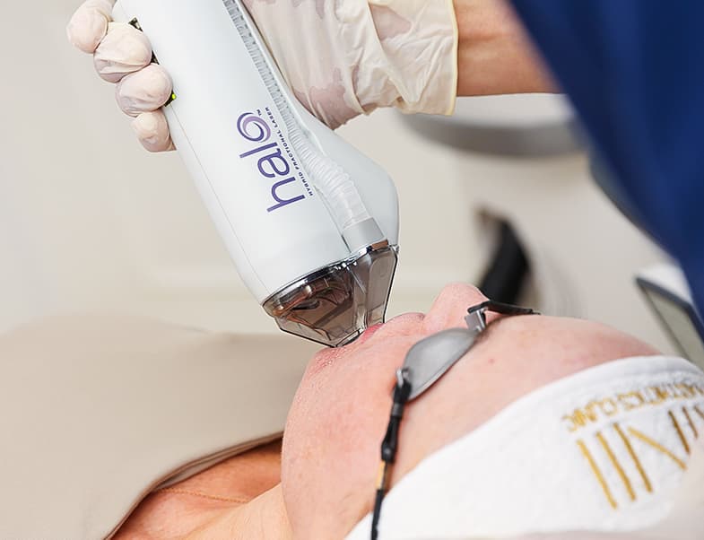 Laser hair removal