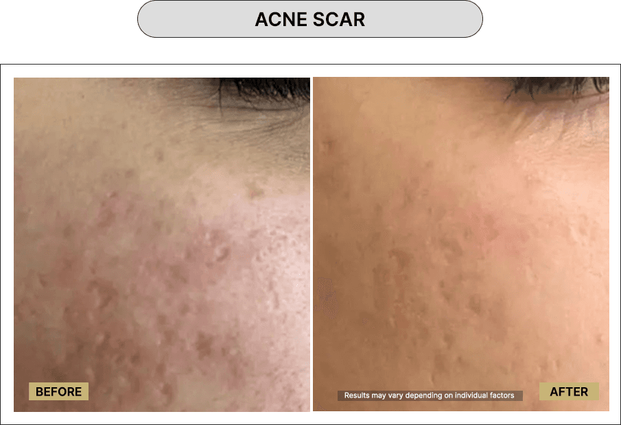 Acne Scar