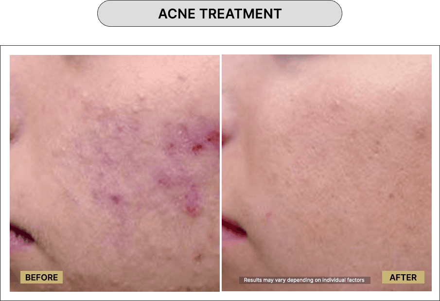 Acne Treatment