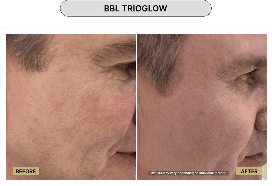 BBL Trioglow