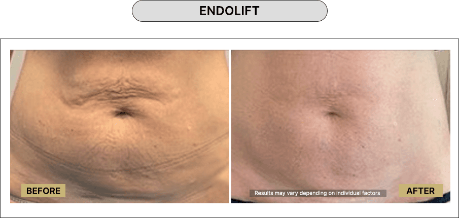 Skin111