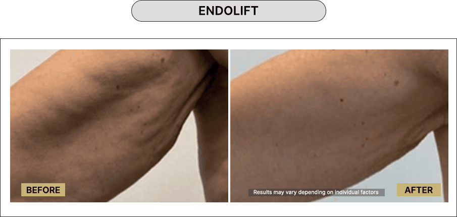 Skin111
