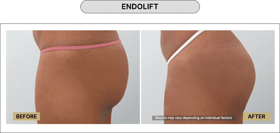 Skin111