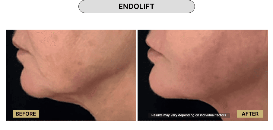 Skin111