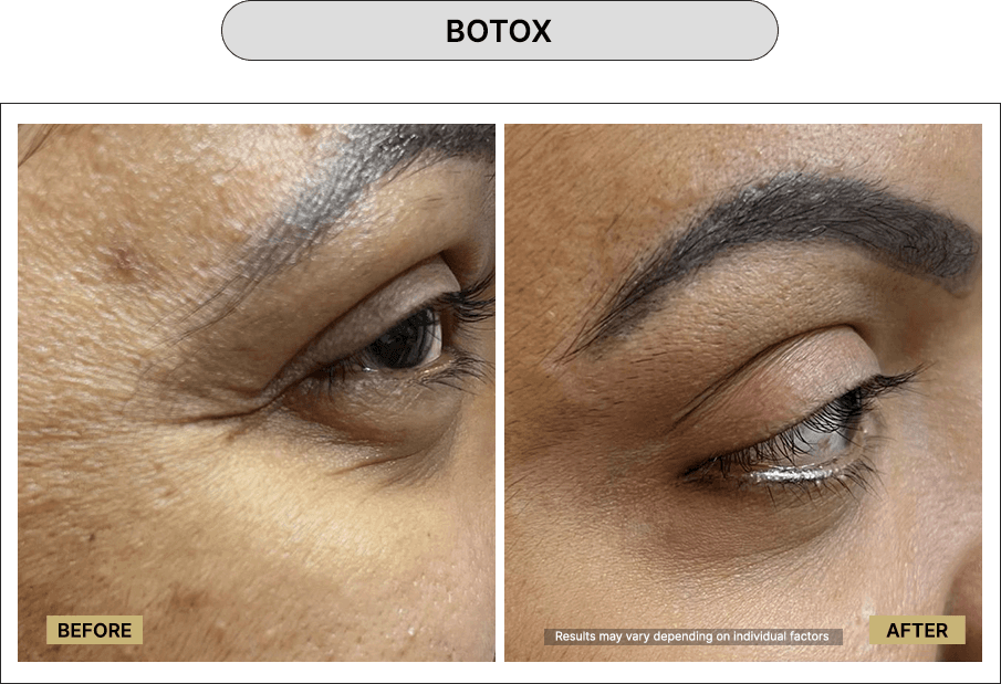 Botox