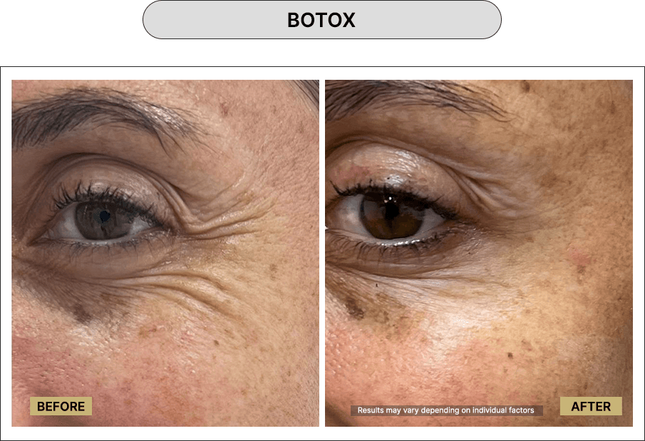 Botox