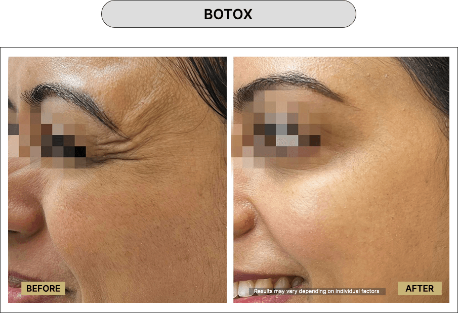 Botox