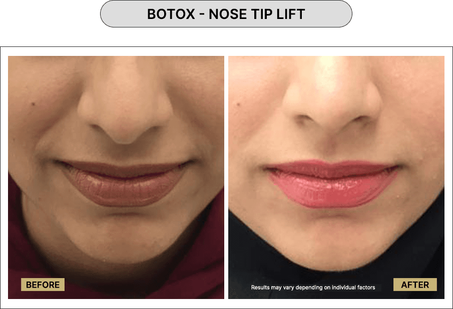 Botox - Nose Tip Lift