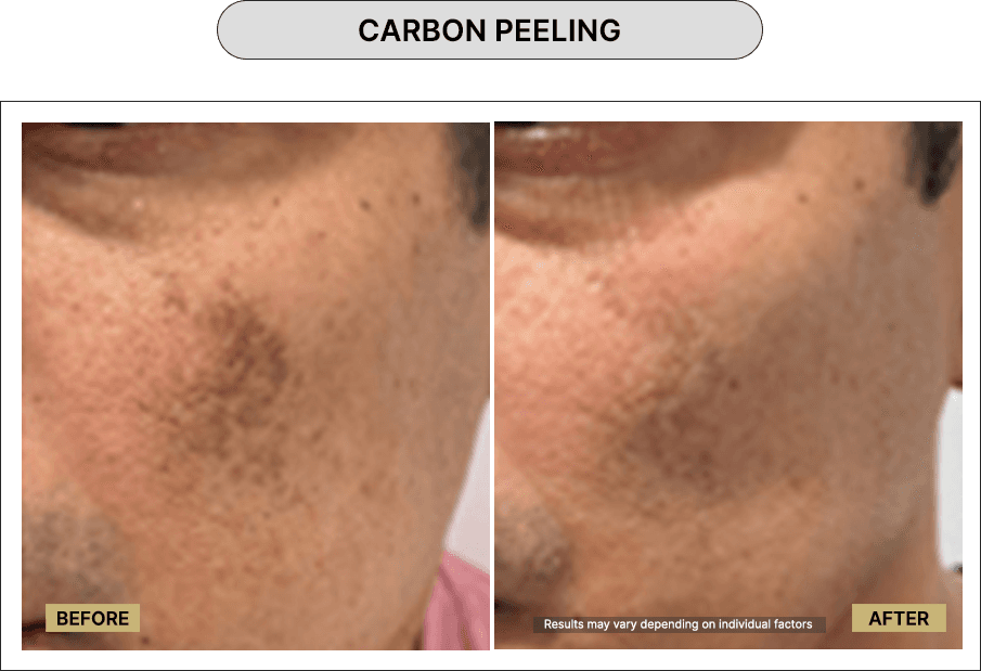 Carbon peeling