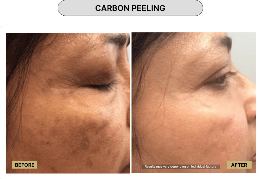 Carbon peeling