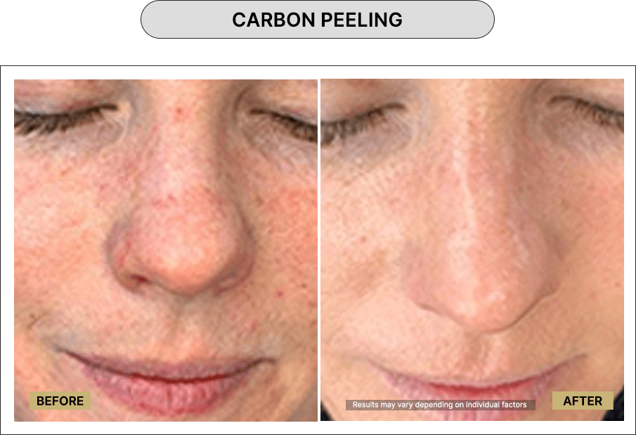 Carbon peeling