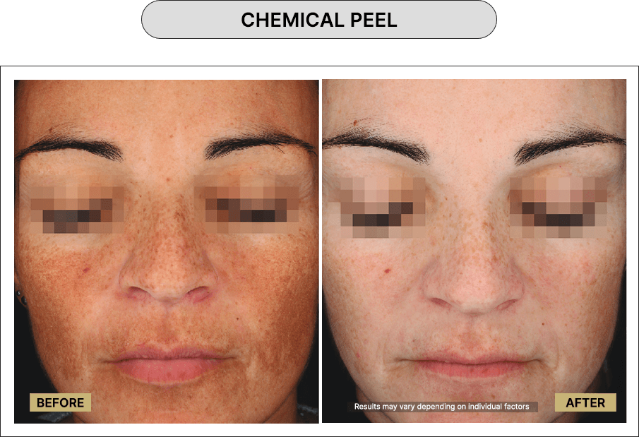 Chemical Peel