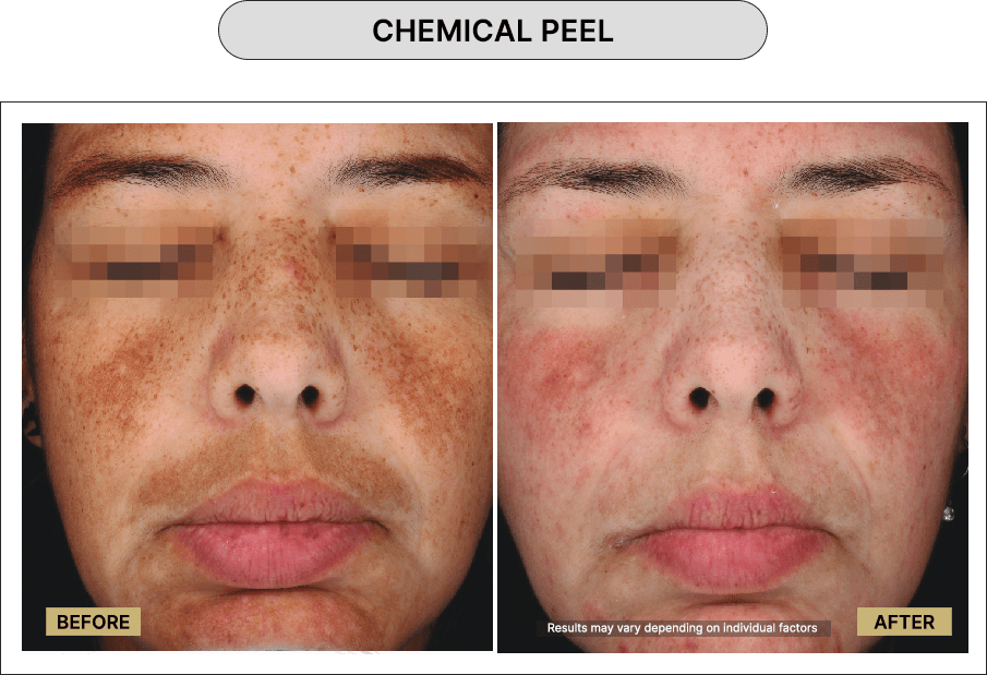 Chemical Peel