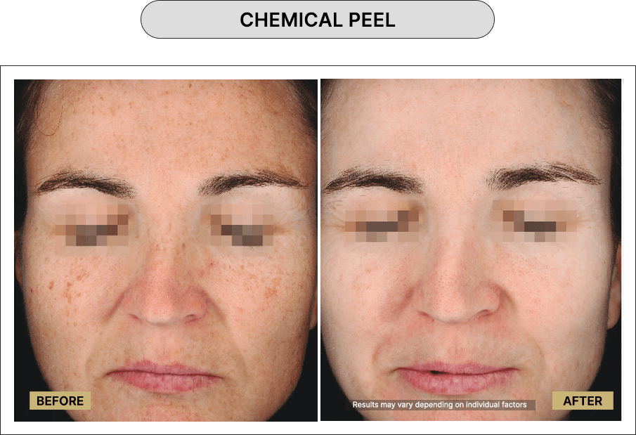 Chemical Peel