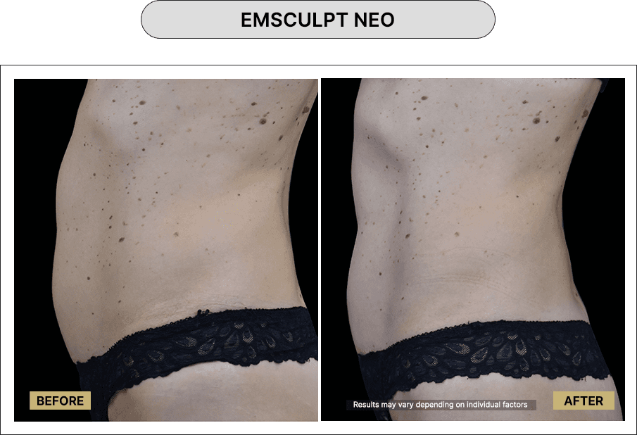 Emsculpt NEO