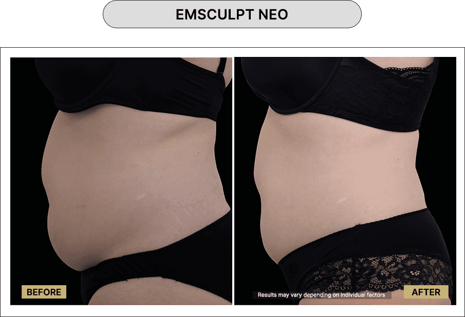 Emsculpt NEO