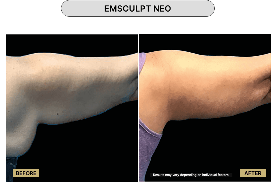 Emsculpt NEO
