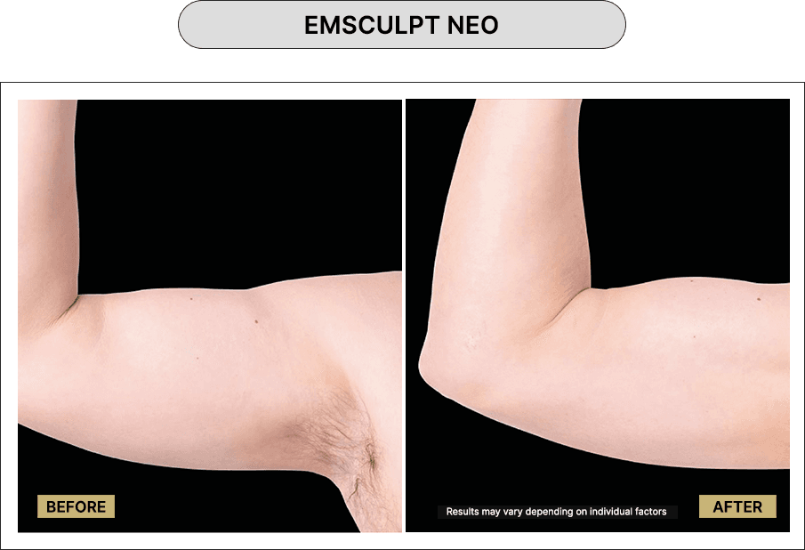 Emsculpt NEO